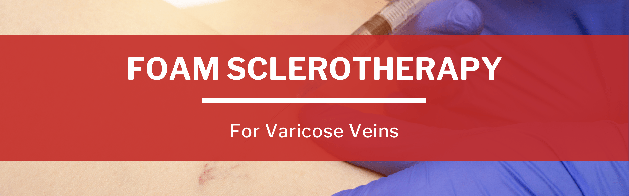 What is Foam Sclerotherapy for Varicose Veins?